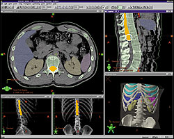 3d Conformal Radiation Therapy