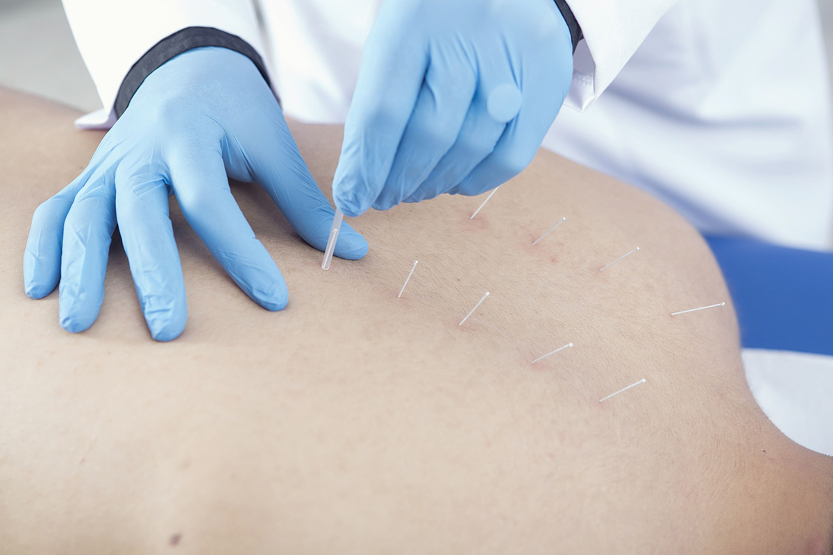 Image of acupuncture procedure