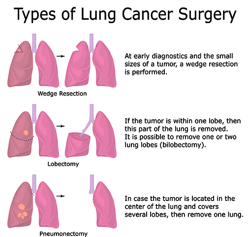 Diagram of 3 types of lung surgery