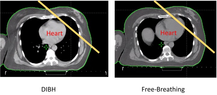 Comparison of Liver Tumor Motion With and Without Abdominal