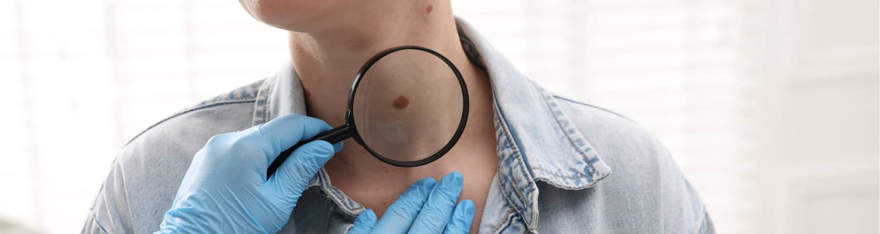 A close-up shows a person's neck with a mole being examined through a magnifying glass by a hand wearing a blue medical glove.