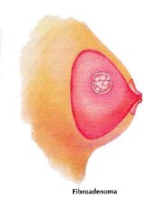 Different Kinds of Breast Lumps