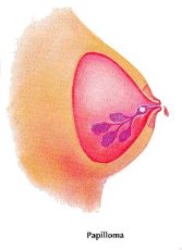 TMR International Hospital - Do Lumps Always Mean Breast Cancer? No, not  all lumps are breast cancer. You should, however, have a doctor check out  any lump. Many are benign (not harmful