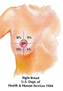 Breast Masses (Breast Lumps) - Gynecology and Obstetrics - Merck