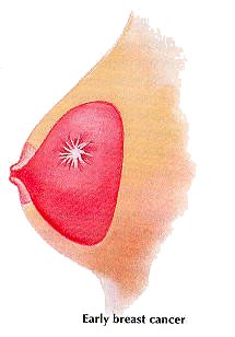 Breast Masses: Cancerous Tumor or Benign Lump?