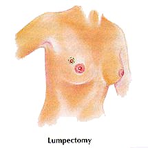 Lumpectomy image