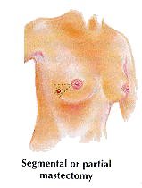 Partial Mastectomy image
