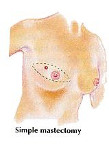 Simple Mastectomy image
