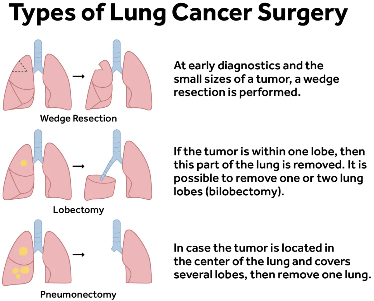 Types of Surgery for Lung Cancer 