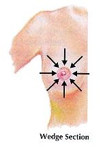 a) well-known breast palpation paths: Spiral (left), Wedges